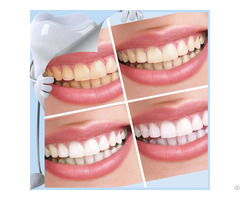 Patent Products Bright Smiles Teeth Whitening Kit