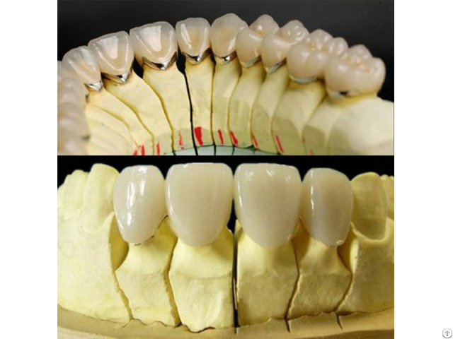 All Ceramic Crown And Bridge Zirconia High Translucent