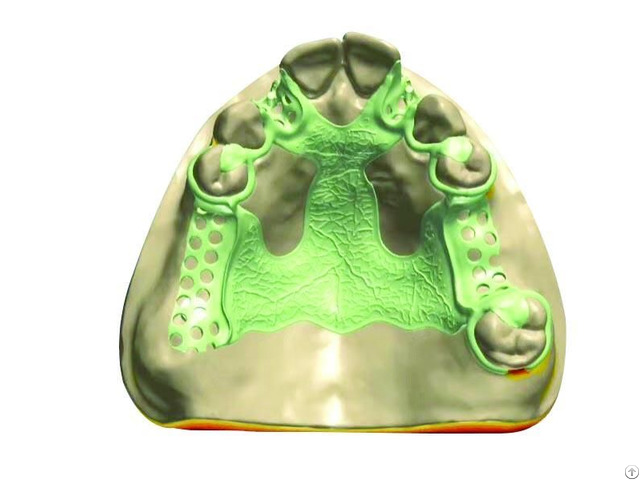 3d Laser Printed Metal Framework China Digital Dental Lab