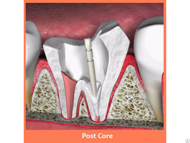 Dental Post Core