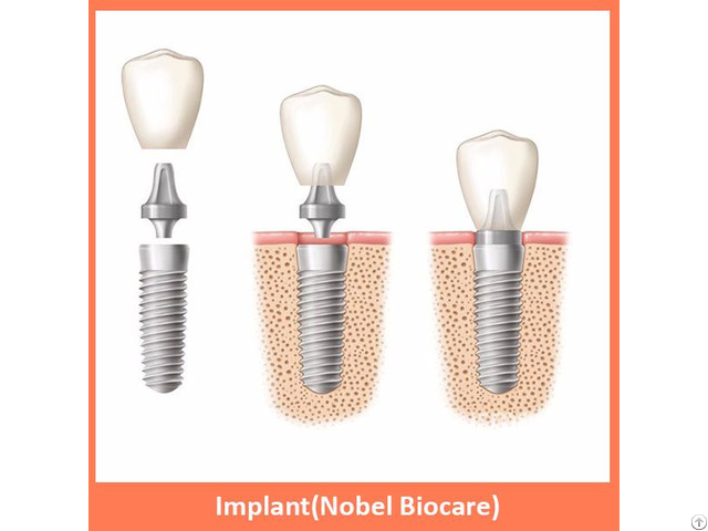 Implant Nobel Biocare