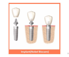 Implant Nobel Biocare