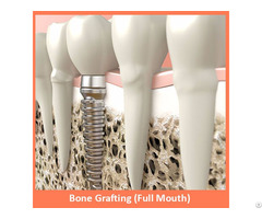 Bone Grafting Full Mouth