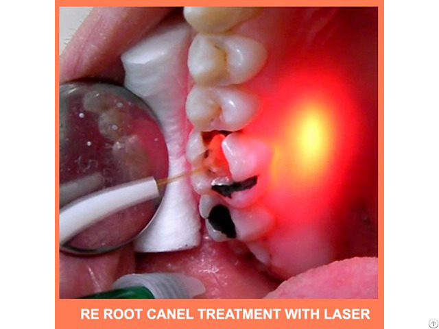 Re Root Canal Treatment With Laser