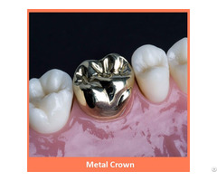 Dental Metal Crown