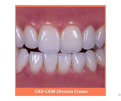 Cad Cam Zirconia Crown